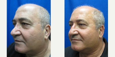 Revision Rhinoplasty before and after photo