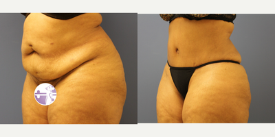 Tummy Tuck before and after photo