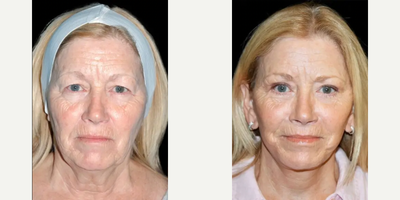 Facelift before and after photo