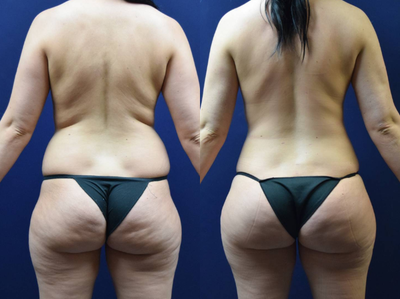 Brazilian Butt Lift before and after photo