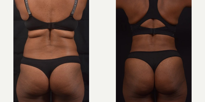 Brazilian Butt Lift before and after photo