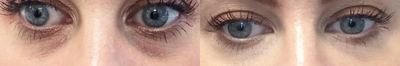 Restylane Silk before and after photo