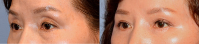 Eyelid Surgery before and after photo