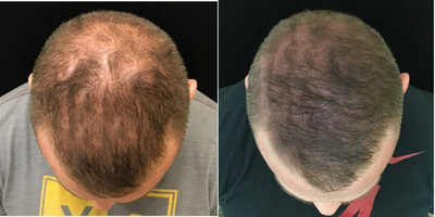 PRP for Hair Loss before and after photo