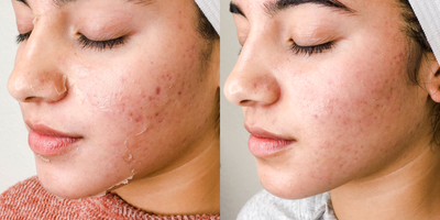 VI Peel before and after photo