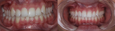 Dental Bonding before and after photo