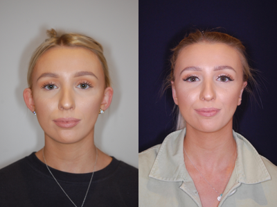 Ear Surgery before and after photo