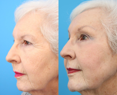 Eyelid Surgery before and after photo