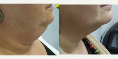 Kybella before and after photo