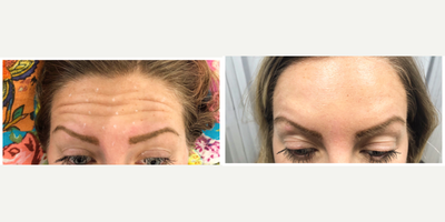 Botox before and after photo