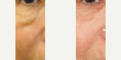 Dermal Fillers before and after photo