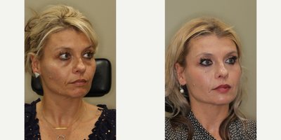 Eyelid Surgery before and after photo