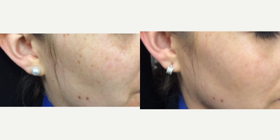 PicoSure before and after photo