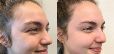 Botox before and after photo