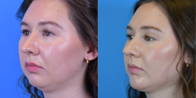 Chin Implant before and after photo