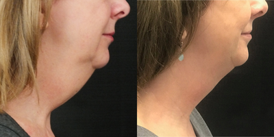 CoolSculpting before and after photo