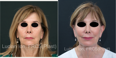 Facelift before and after photo