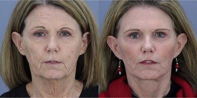 Facial Fat Transfer before and after photo