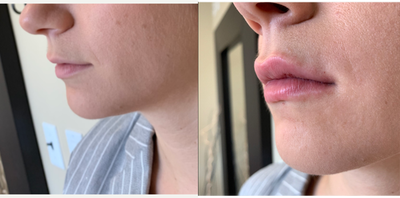 Lip Fillers before and after photo