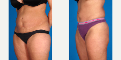 Liposuction before and after photo