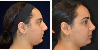 Rhinoplasty before and after photo