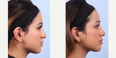 Rhinoplasty before and after photo