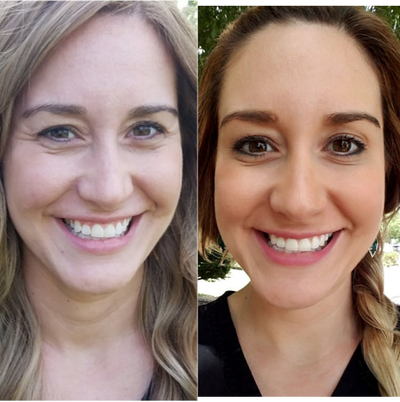 Botox before and after photo