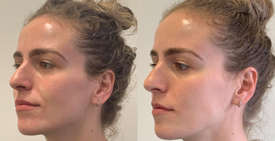 Restylane Defyne before and after photo