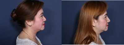 Rhinoplasty before and after photo