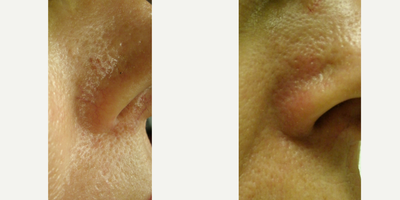 YAG Laser before and after photo