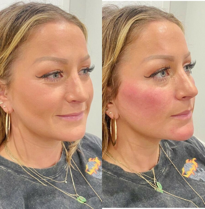 Chin Filler before and after photo