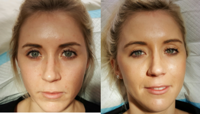 Juvederm before and after photo