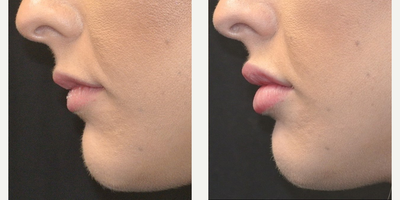 Lip Fillers before and after photo
