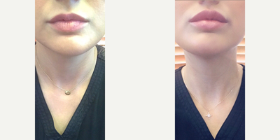 Restylane before and after photo