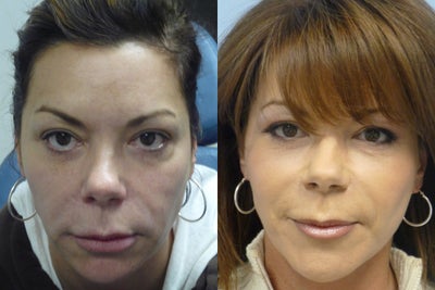 Facelift before and after photo