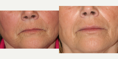Lip Fillers before and after photo