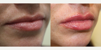 Lip Fillers before and after photo