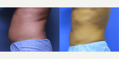 Liposuction before and after photo
