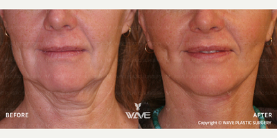 Mini Facelift before and after photo