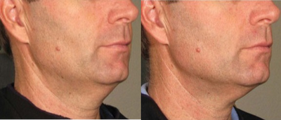 Ultherapy before and after photo