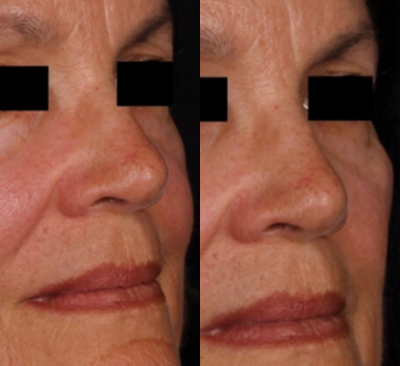 Voluma before and after photo