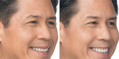 Botox before and after photo