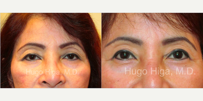 Double Eyelid Surgery before and after photo
