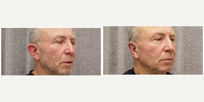 Ear Surgery before and after photo