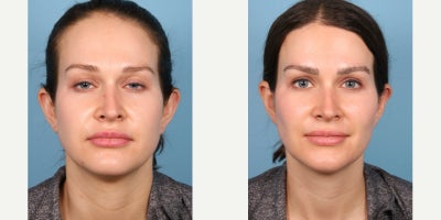 Ear Surgery before and after photo
