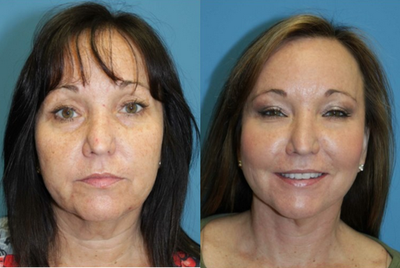 Facelift before and after photo