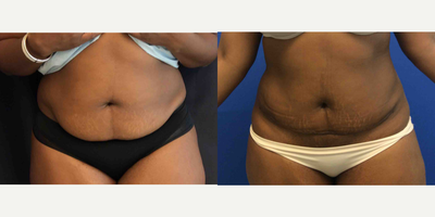 Mini Tummy Tuck before and after photo