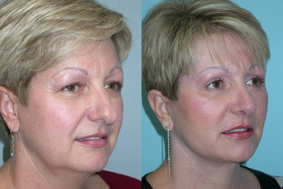 Rhinoplasty before and after photo