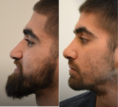 Rhinoplasty before and after photo