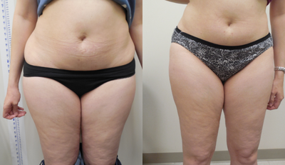 Velashape before and after photo